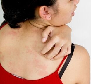 granulomos ant kūno - parazitų buvimo simptomai