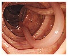 parazitai žmogaus organizme