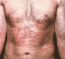 probleminė oda yra parazitų buvimo požymis