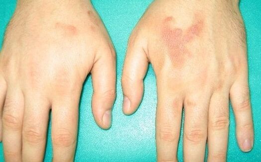 rankų sąnarių skausmas gali būti parazitų simptomai